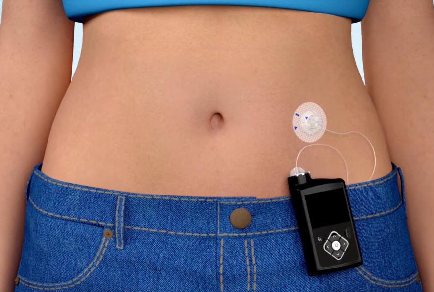 Insulin infusion device